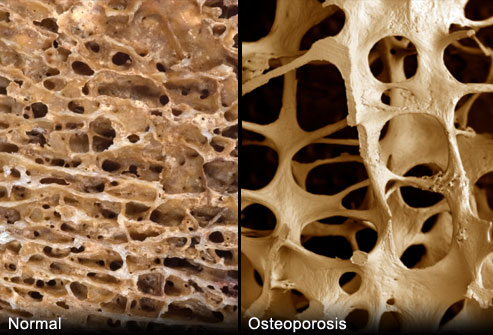 Osteoporosis